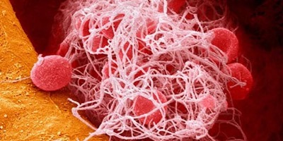 Что такое тромб?