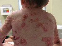 Акантолиз буллезный