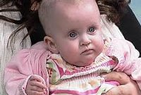 Синдром Барттера