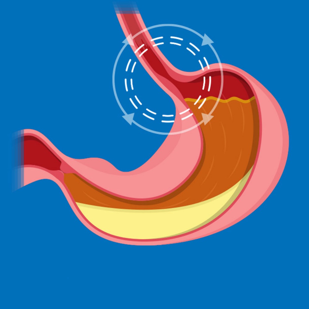 Пищевод Барретта