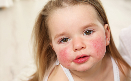 Как работают эмоленты и как они облегчают дерматиты