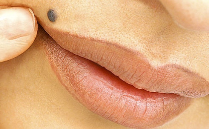 Предупреждающие признаки рака кожи