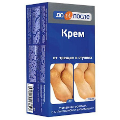 До и после крем для ног от трещин в ступнях 150 мл
