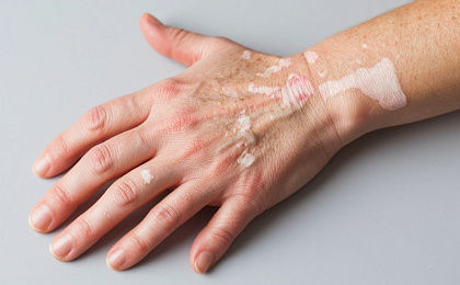 Псориаз: причины, симптомы и лечение