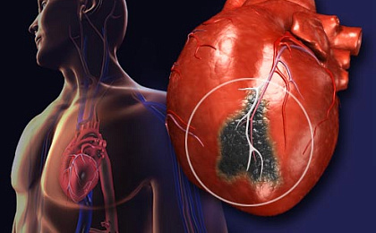 Инфаркт, что это?