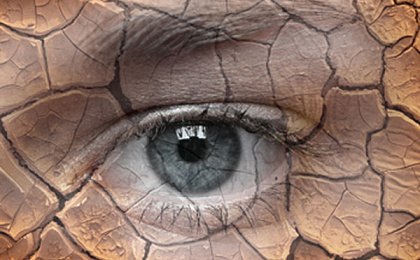 Синдром сухих глаз