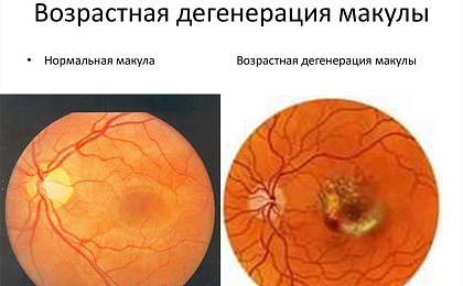Что такое возрастная дегенерация макулы?