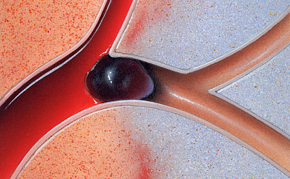 Инсульт: Что Вам нужно знать