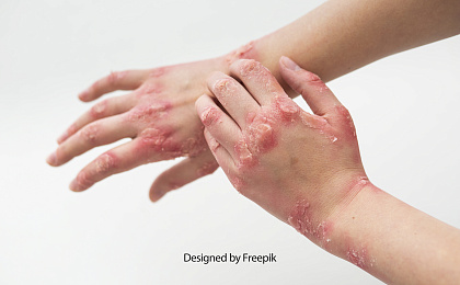 Руководство по псориазу